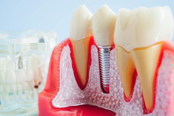 What Your Oral Surgeon Wants You To Know About Dental Implants