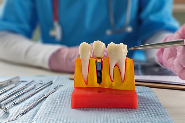 The Role Of Dental Implants In Your Oral Health And Function