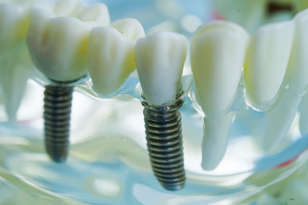 Benefits To Replace Missing Teeth With Dental Implants