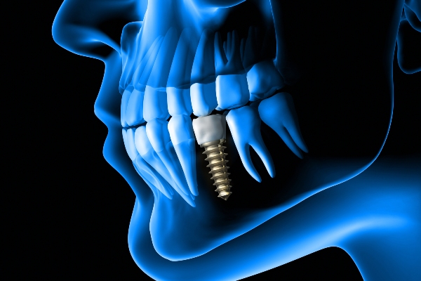 Dental Implants    : What You Need To Know