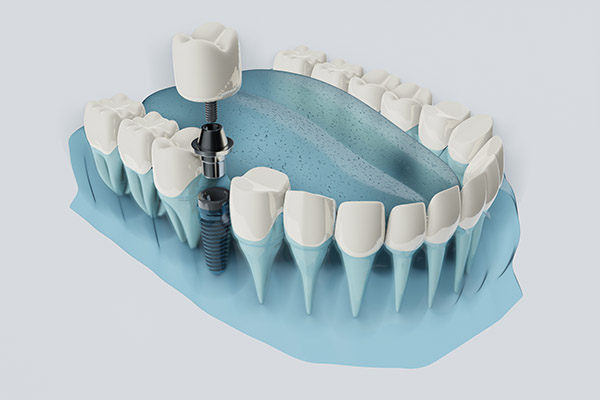 How Dental Implants Prevent Bone Loss