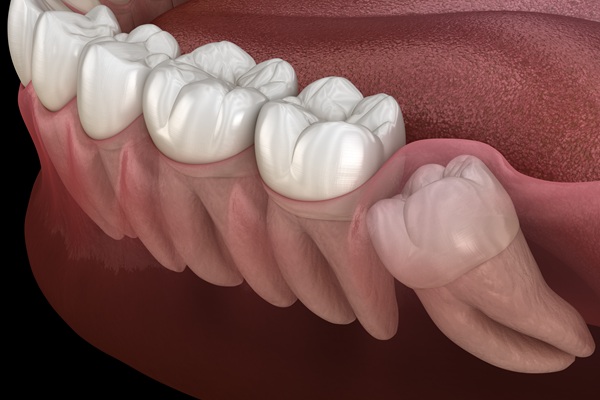 Understanding Impacted Teeth: Causes And Treatment Options
