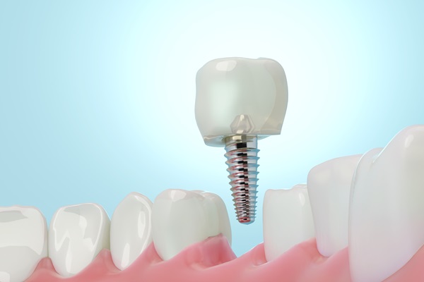 Single Tooth Replacement With Dental Implants: A Complete Guide